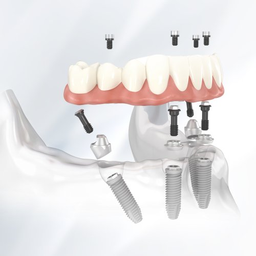 All-on-4 technológia 3D orvosi szemléltetése